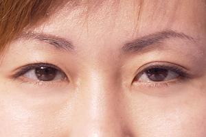 太田母斑を効果的に治療するクリニック